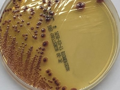 Bacteriuria asintomática